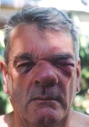 Bruisedfront